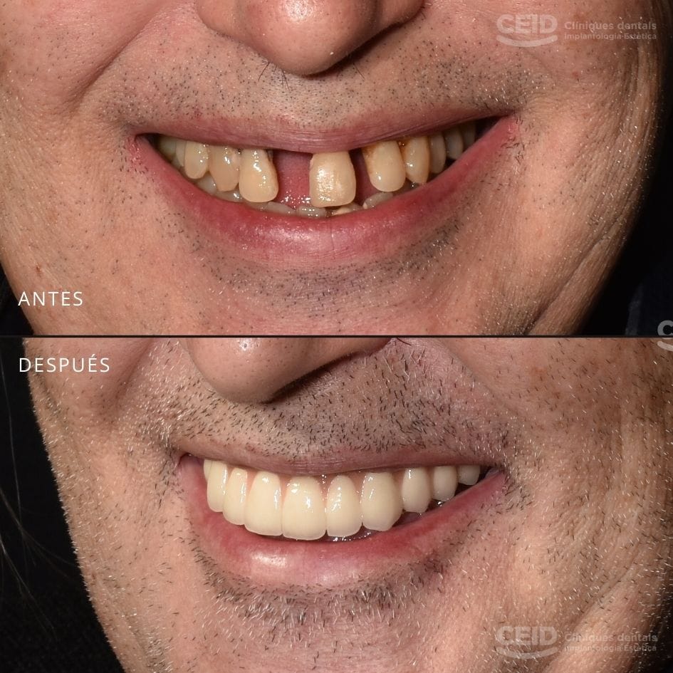 antes-despues-implantes-dentales-carga-inmediata-barcelona