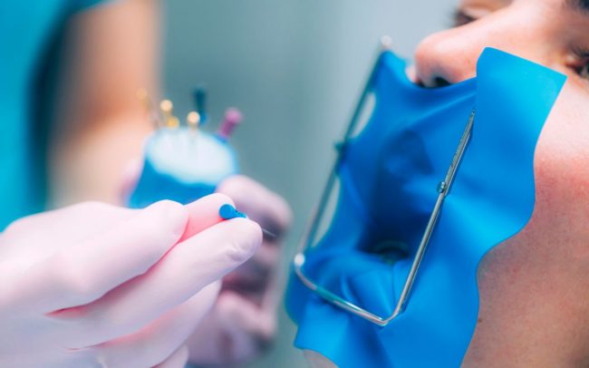 endodoncia-barcelona