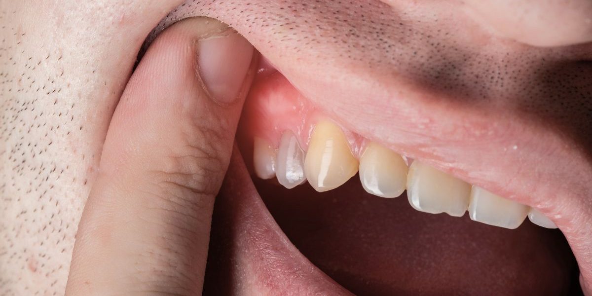 fistulas-dentales-tratamiento-barcelona-CEID fistulas-dentales-tratamiento-barcelona-CEID