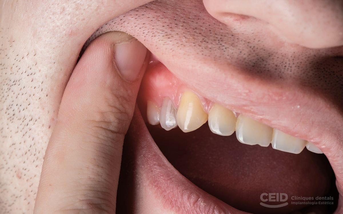 fistulas-dentales-tratamiento-barcelona-CEID