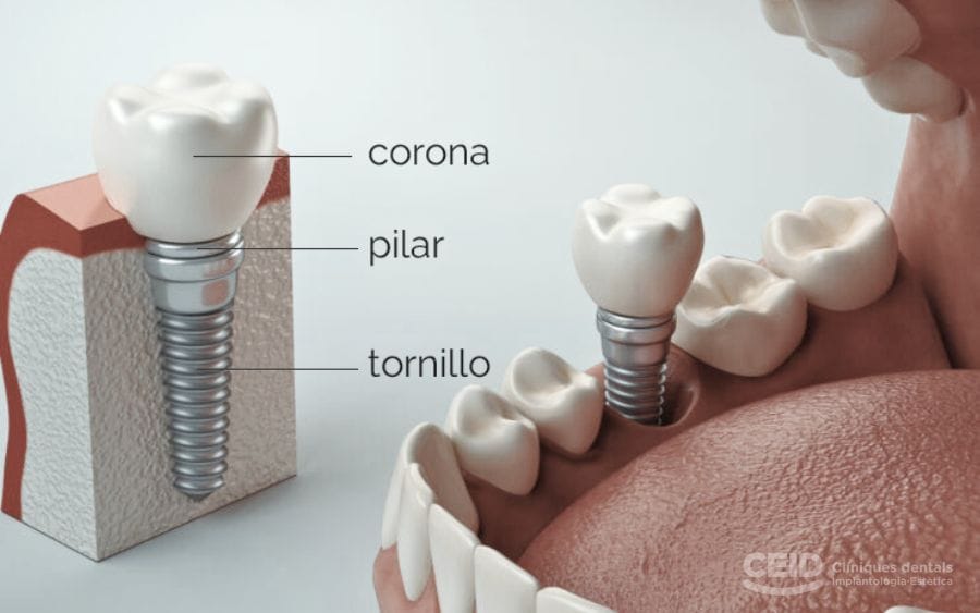 partes-implante-dental-ceid