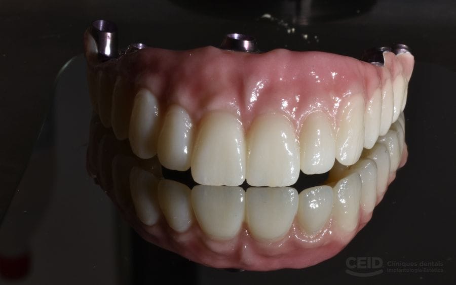protesis-implantes-dentales-barcelona-ceid-arcada