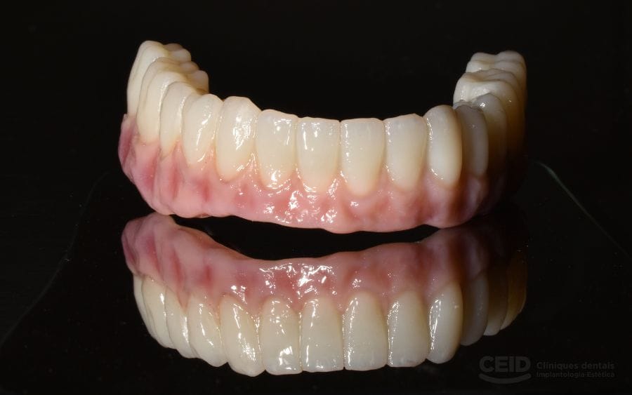 protesis-implantes-dentales-barcelona-ceid-inferior