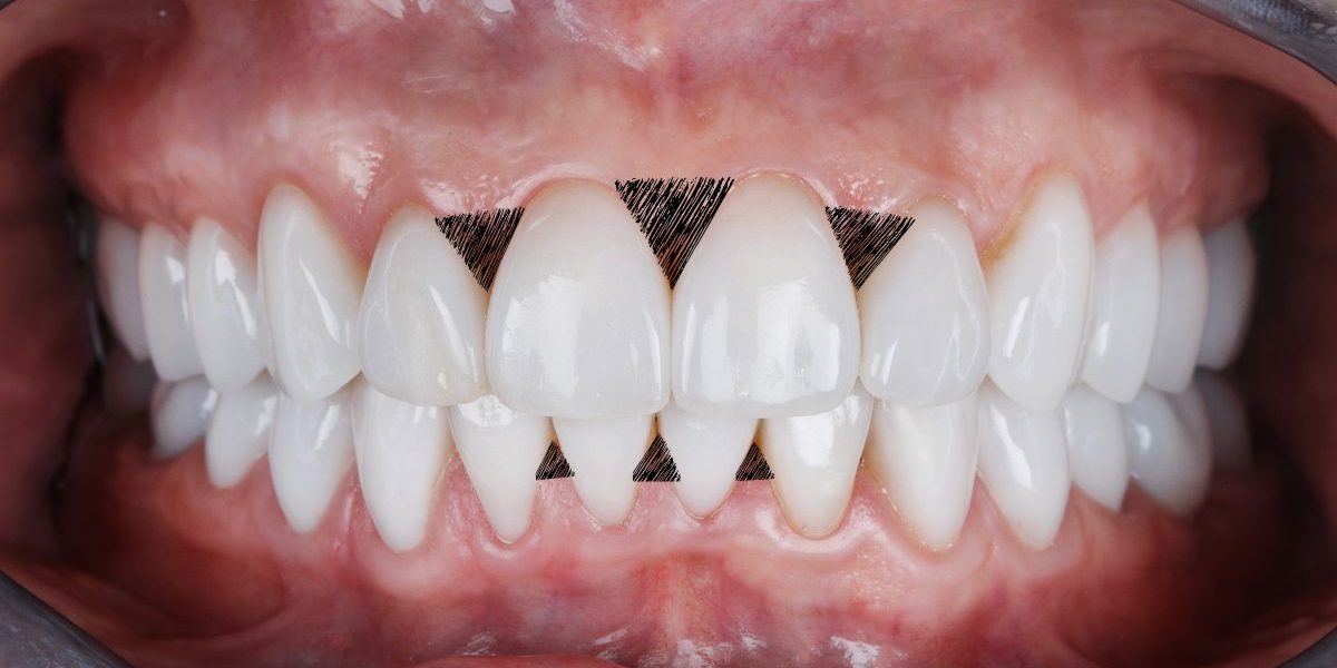 carillas-dentales-para-triangulos-negros