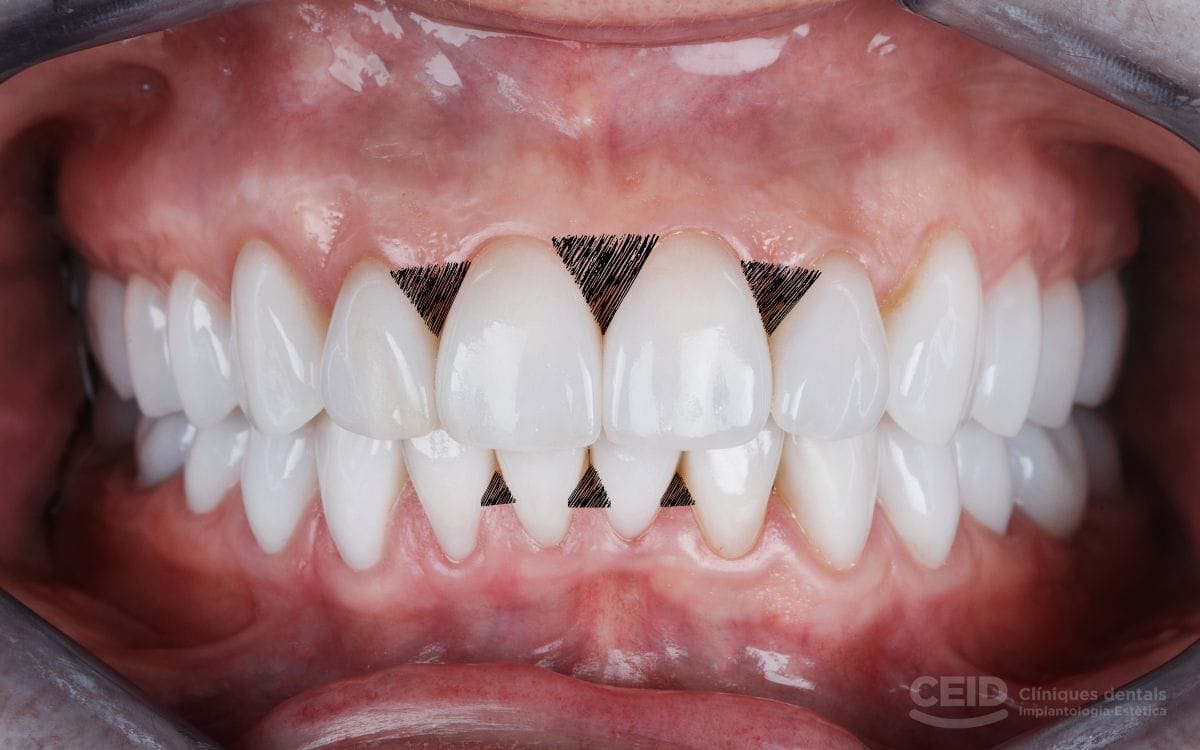 carillas-dentales-para-triangulos-negros