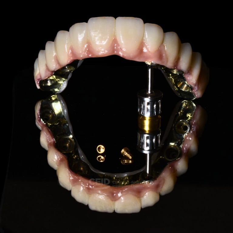 Prótesis dental de alta gama en Barcelona