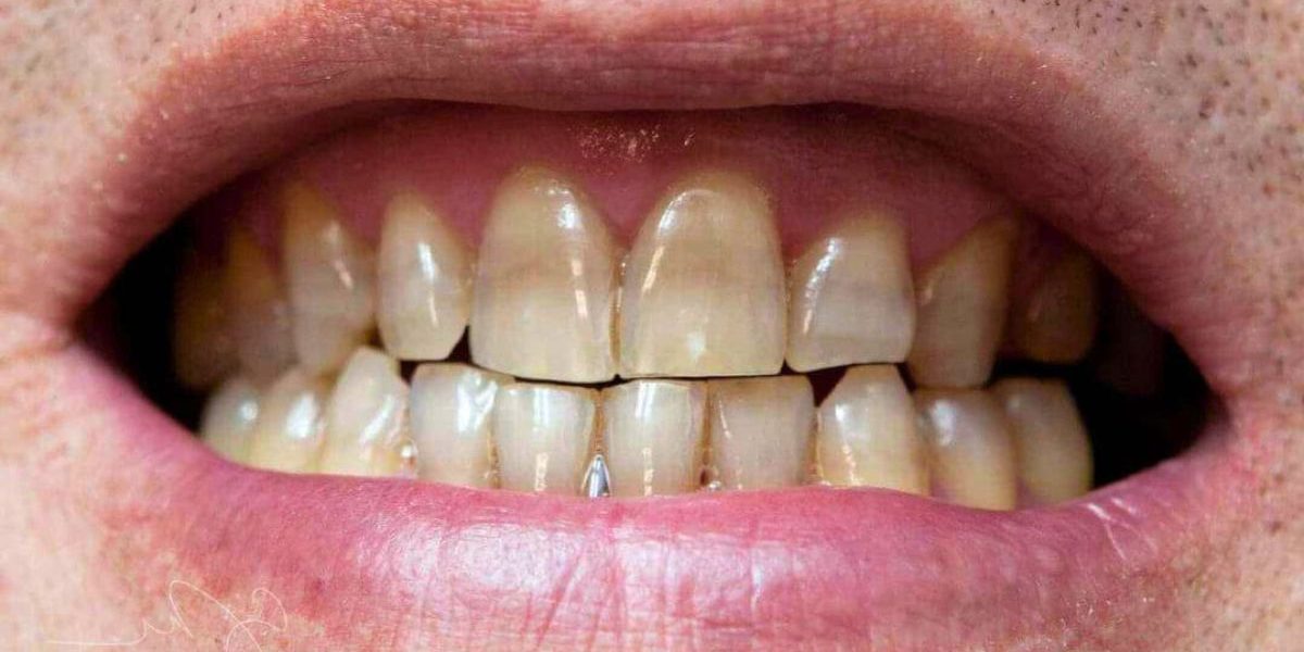 manchas-tetraciclinas-carillas-dentales manchas-tetraciclinas-carillas-dentales