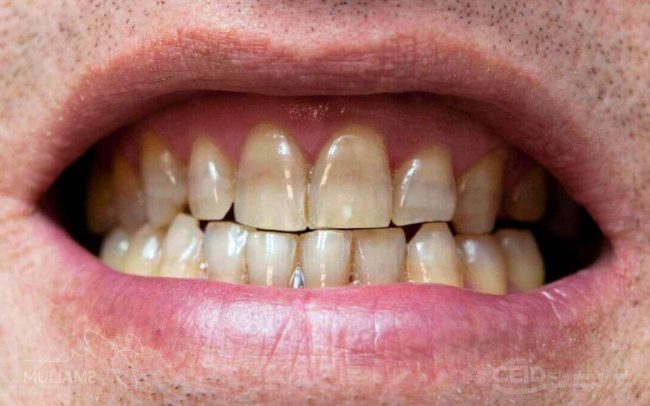manchas-tetraciclinas-carillas-dentales manchas-tetraciclinas-carillas-dentales