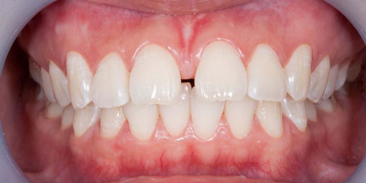 que-son-los-diastemas que-son-los-diastemas