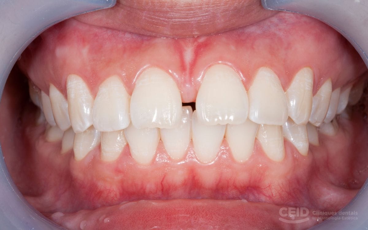 que-son-los-diastemas