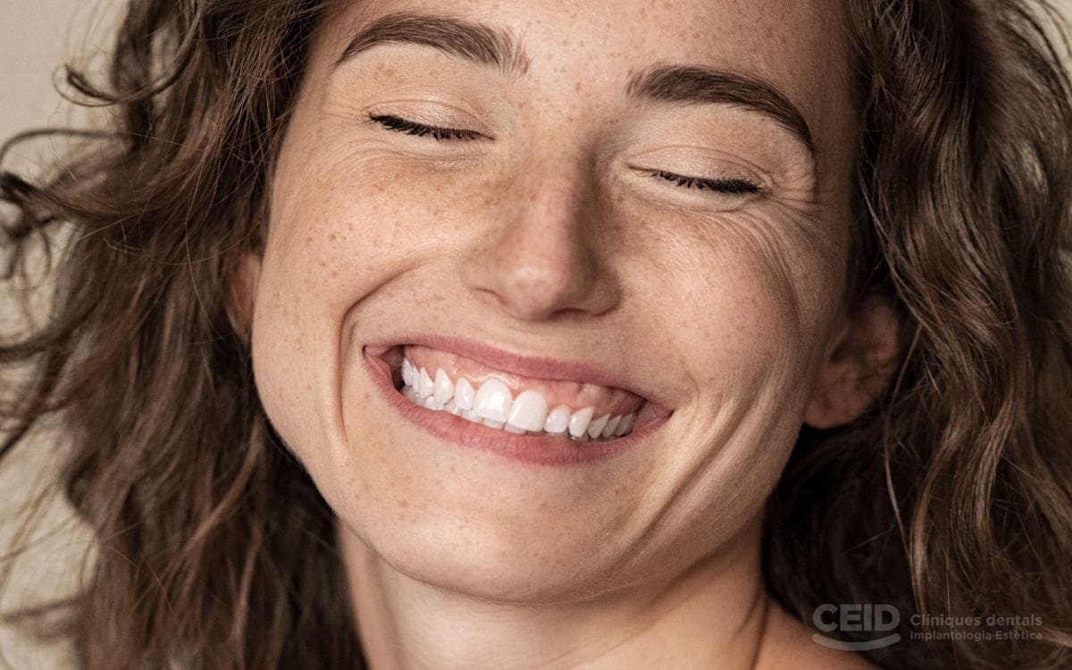 sonrisa-gingival-tratamiento-en-barcelona-ceid