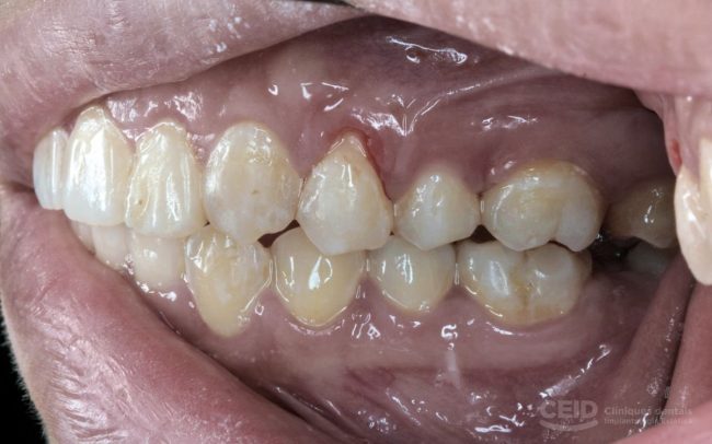 retraccion-encias-problema-solucion