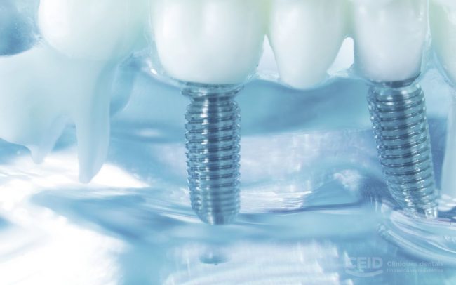 CEID Implantes nobel biocare