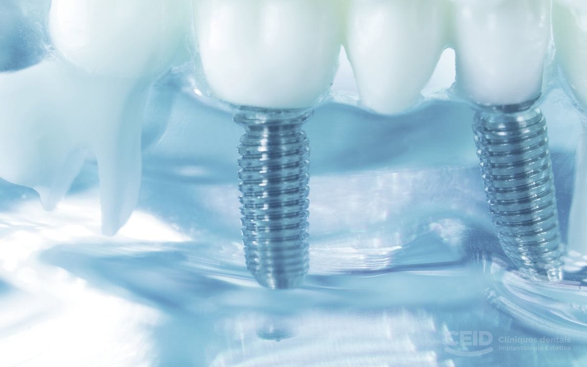 CEID Implantes nobel biocare