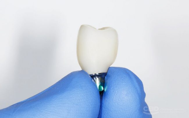 CEID - implantes zirconio monolítico