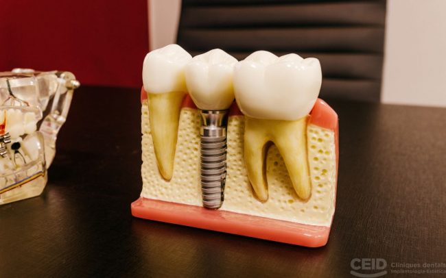 Injerto de encía sobre implante
