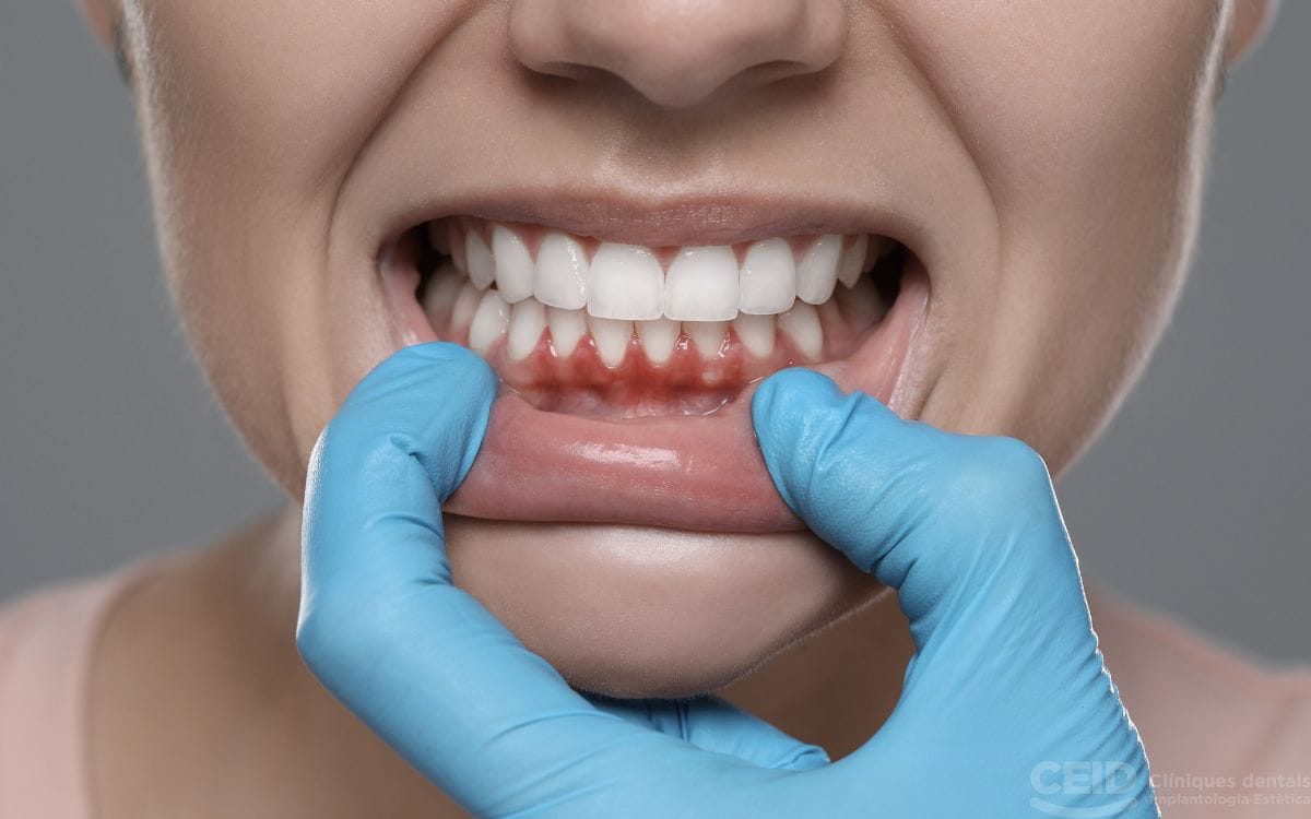 tratamiento periodontitis