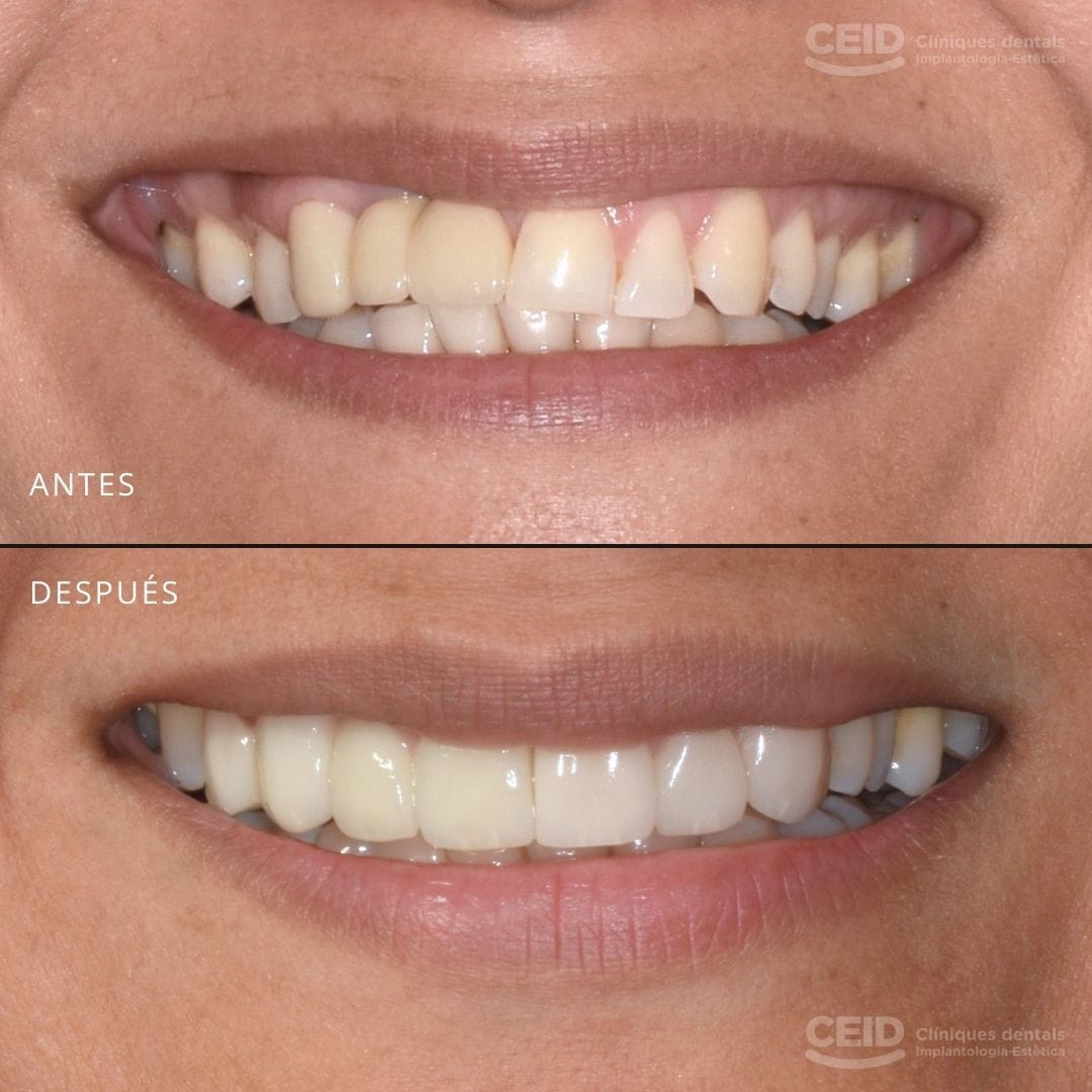 caso-antes-despues-carillas-dentales-barcelona-web