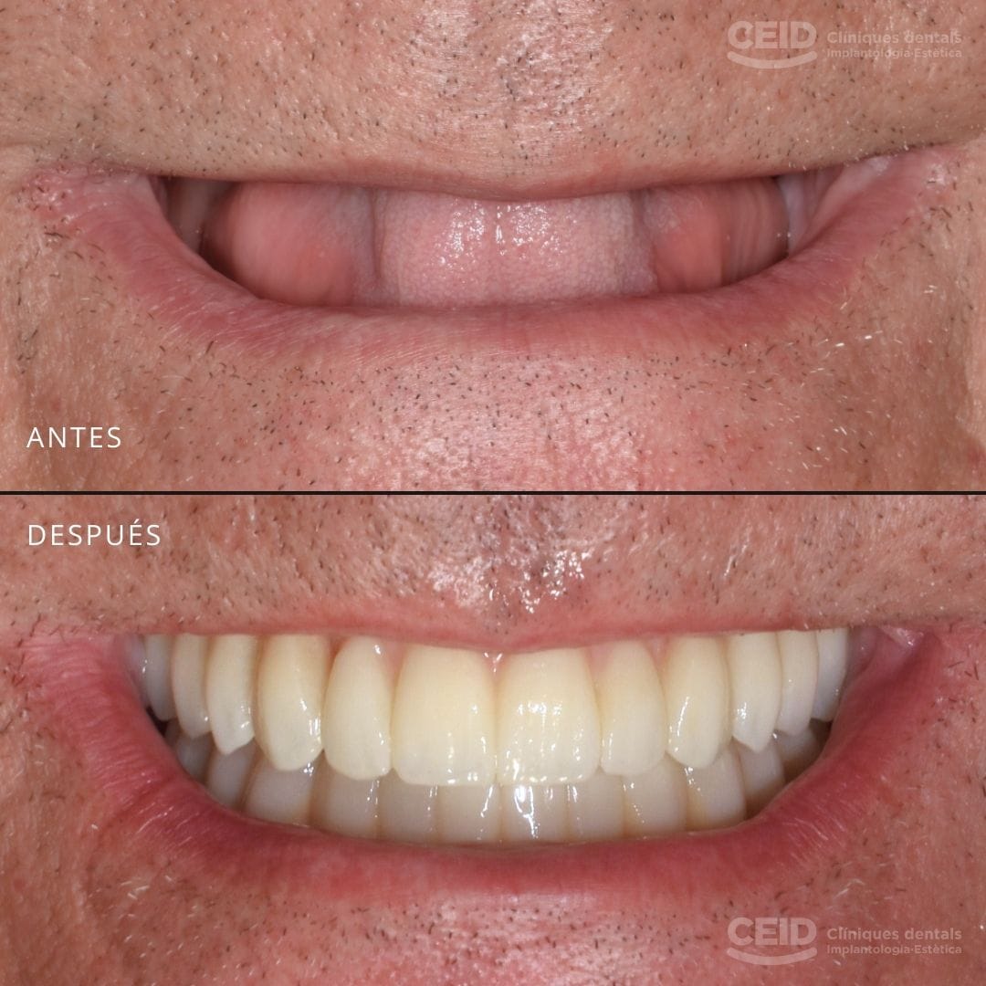 caso-antes-despues-implantes-dentales-carga-inmediata-barcelona