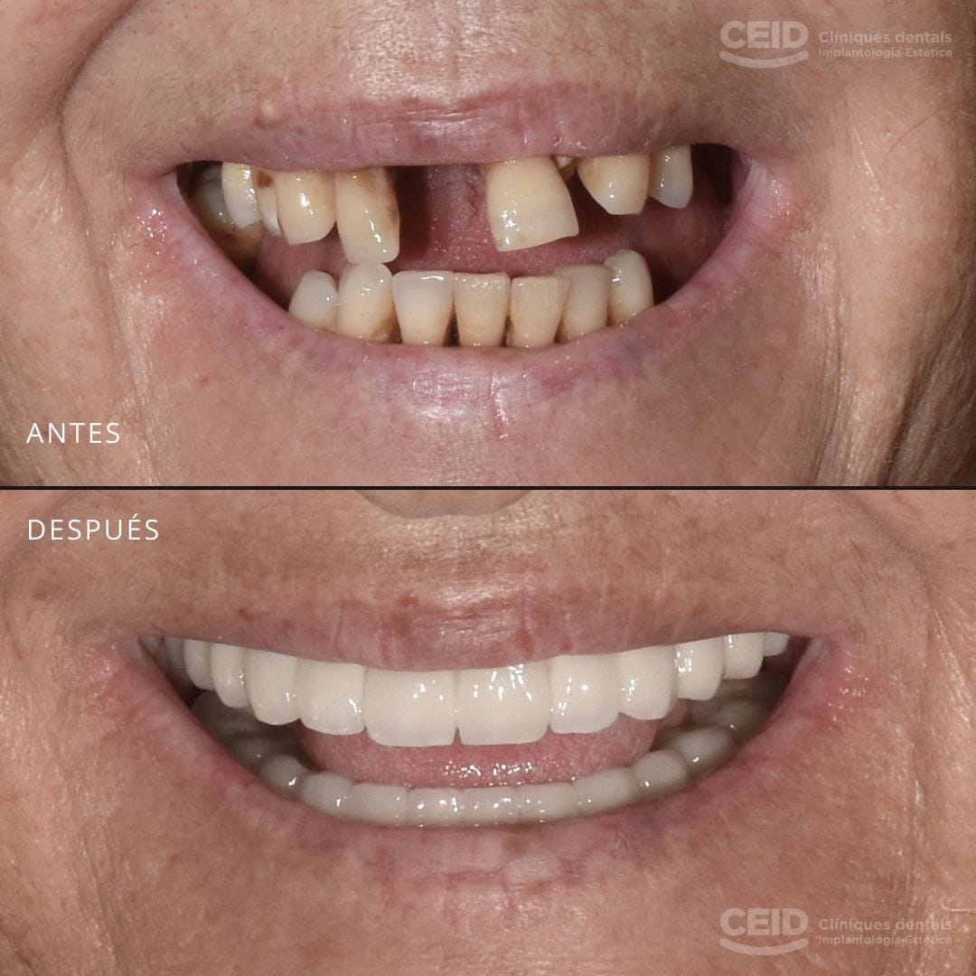 caso-antes-despues-protesis-dentales-barcelona-ceid