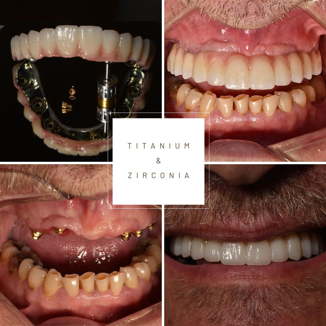 protesis-sobre-implantes-barcelona-ceid