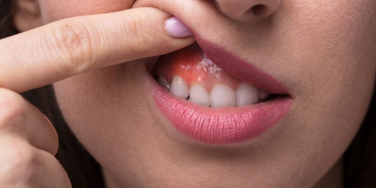 Injerto de encía necesario