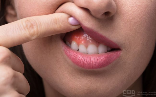 Injerto de encía necesario