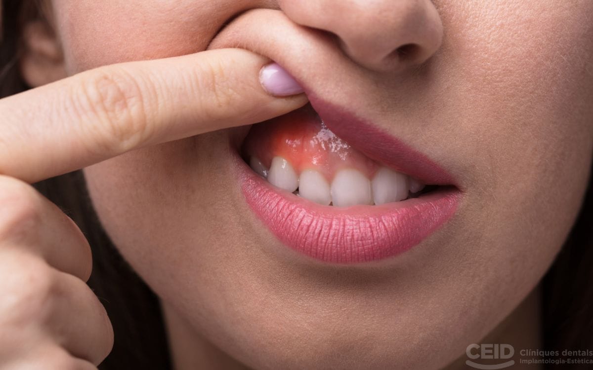 Injerto de encía necesario