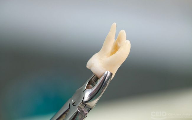 La conexión entre la enfermedad de las encías y la pérdida de dientes