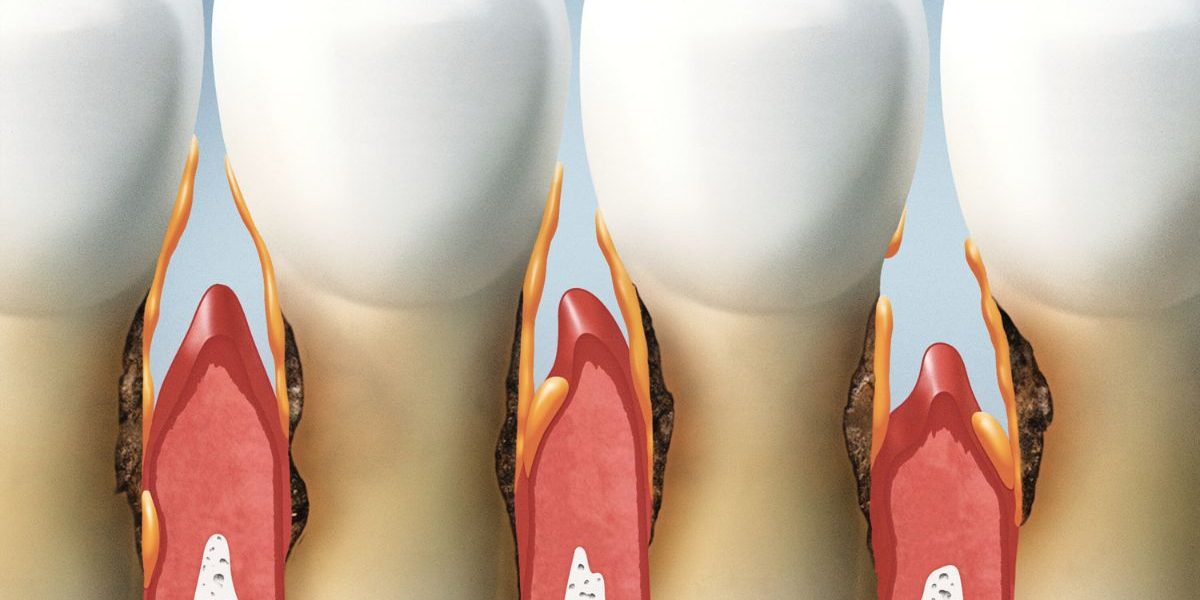 CEID – Recesión de encías Recesión de encías