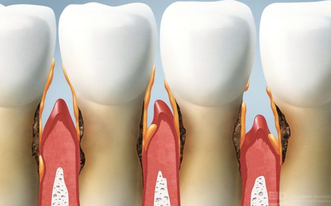 Recesión de encías
