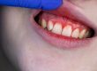 Sangrado de encías
