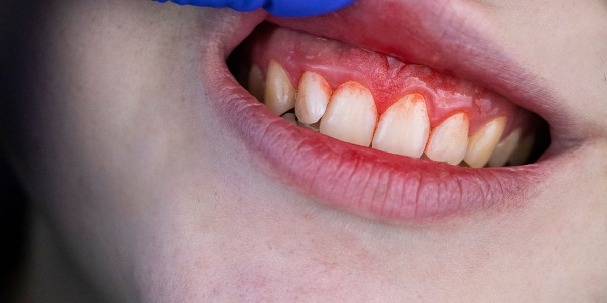 Sangrado de encías