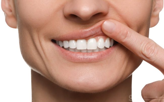 curetaje periodoncia