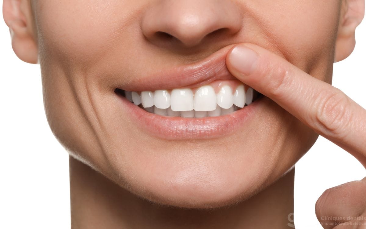 curetaje periodoncia