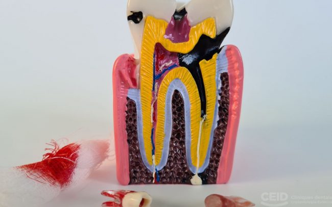 CEID – Caries dentales Caries dentales