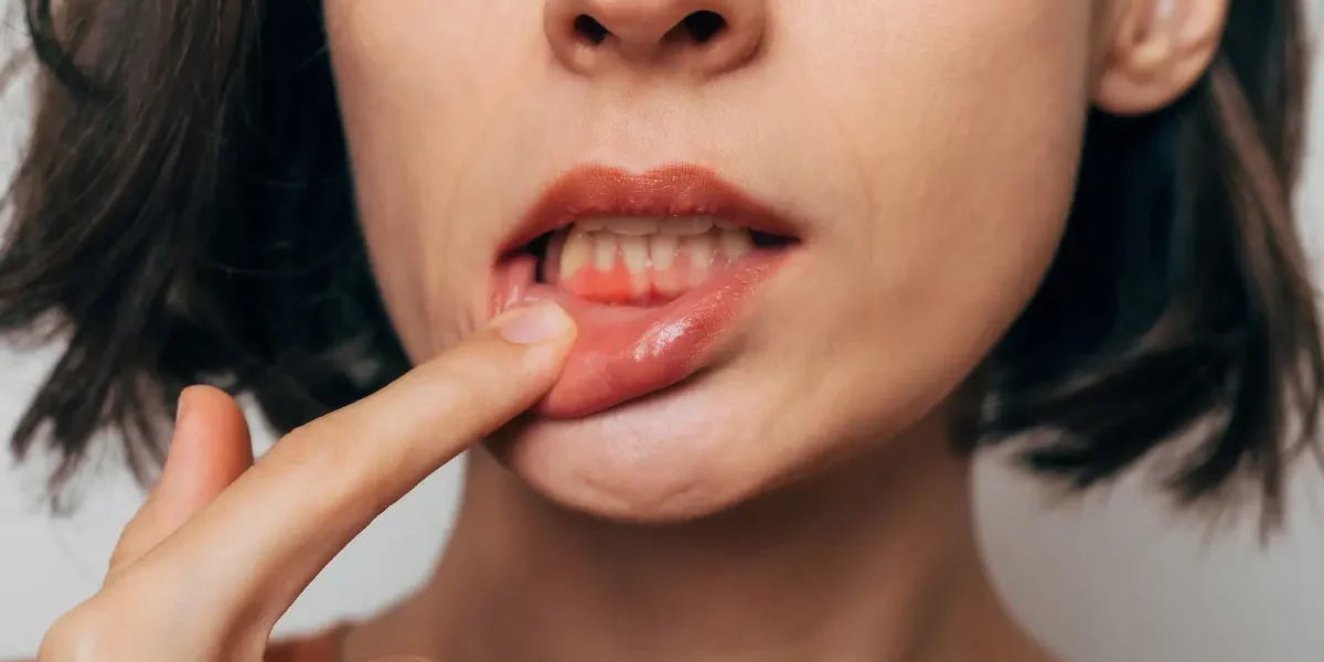 CEID – Opciones para regenerar encías