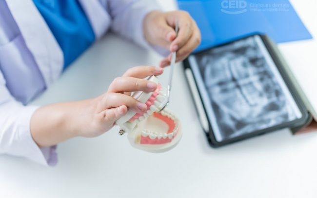 CEID – Regeneración ósea Regeneración ósea