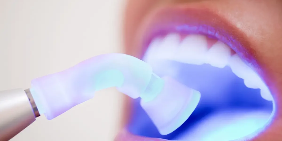 Empaste Estetico Barcelona