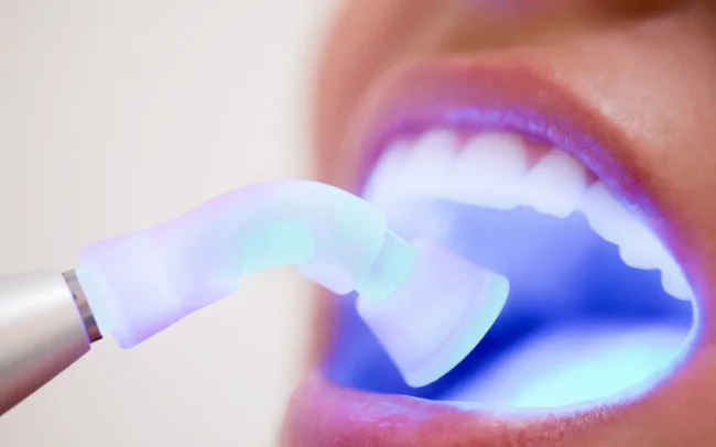 Empaste Estetico Barcelona