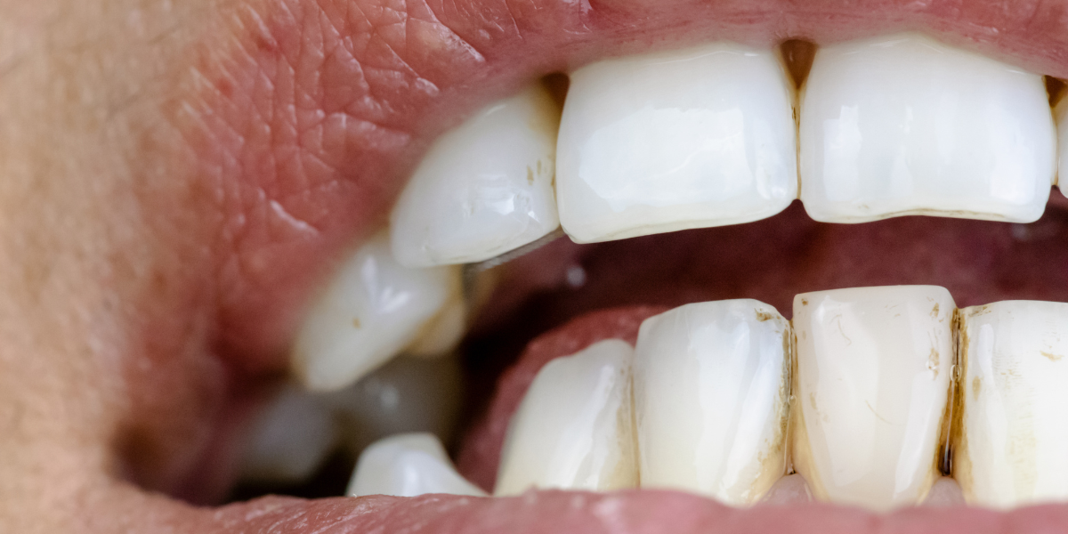 CEID – manchas dentales manchas dentales