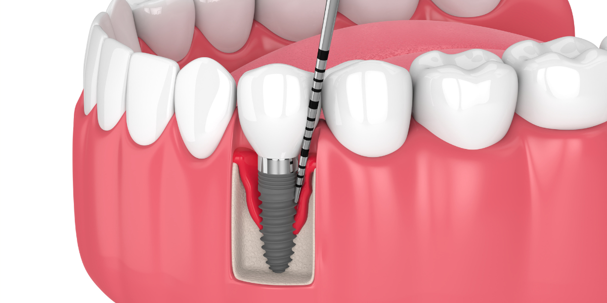 CEID – tratamiento periimplantitis tratamiento periimplantitis