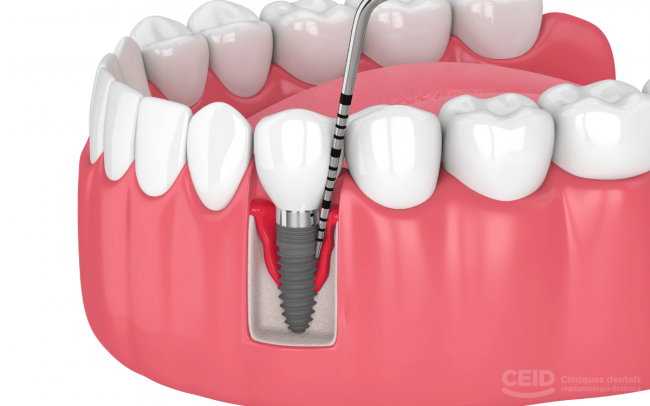 tratamiento periimplantitis