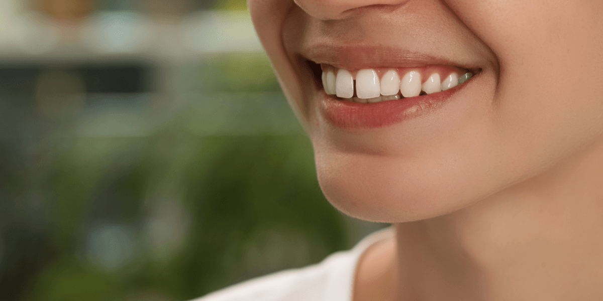 CEID – Carillas dentales para cerrar espacios interdentales Carillas dentales para cerrar espacios interdentales