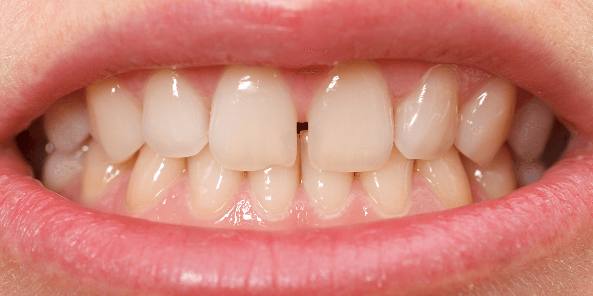 CEID – Espacios interdentales Espacios interdentales