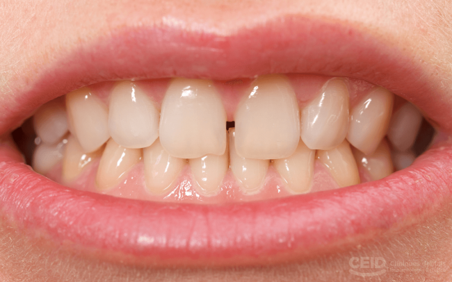 Espacios interdentales