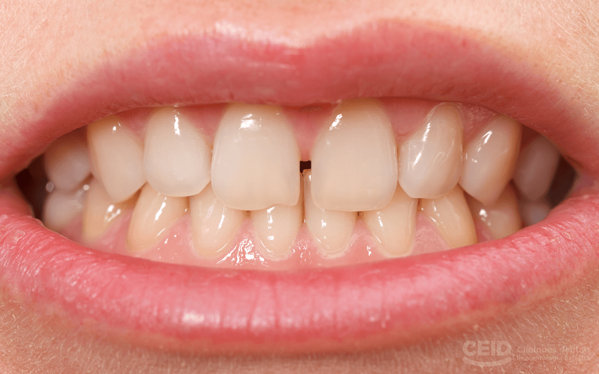 Espacios interdentales