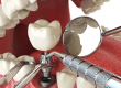 preoperatorio de implantes dentales