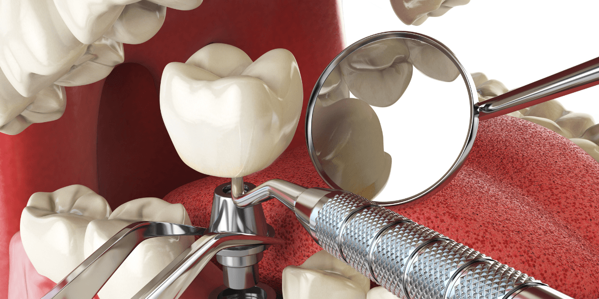 preoperatorio de implantes dentales