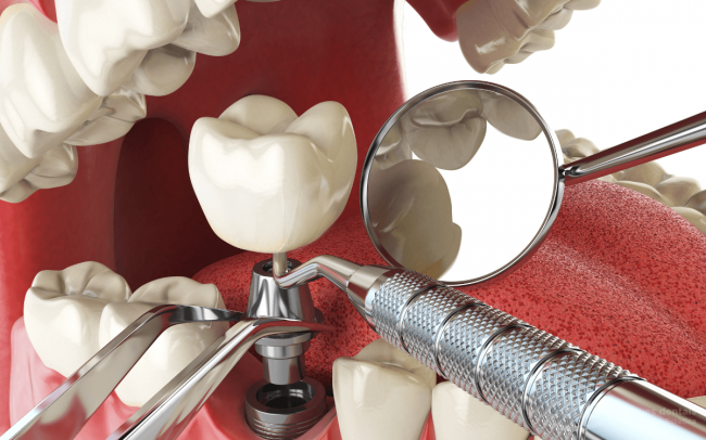 preoperatorio de implantes dentales